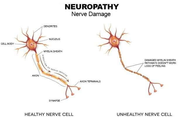 Neuropathy-Nerve-Damage